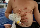 تفاقم انتشار مرض جدري الماء في قطاع غزة