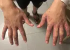 الجرب يجتاح زنازينهن