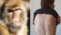 هروب شاب أمريكي مصاب بجدري القرود من المستشفى
