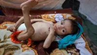 طفل من غزة يعاني من سوء التغذية