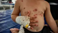 تفاقم انتشار مرض جدري الماء في قطاع غزة