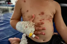 تفاقم انتشار مرض جدري الماء في قطاع غزة
