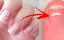 العلامات البيضاء على الاظافر