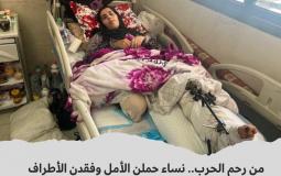 سيدة فقدت ساقها في الحرب