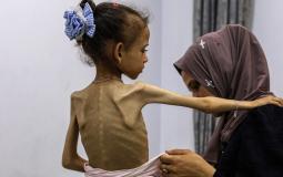 طفلة في غزة تعاني من سوء التغذية. يواجه قطاع غزة خطرا شديدا لحدوث المجاعة، فيما تزداد التقارير عن وفاة أشخاص بسبب الجوع وسوء التغذية