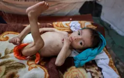 طفل من غزة يعاني من سوء التغذية