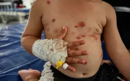 تفاقم انتشار مرض جدري الماء في قطاع غزة