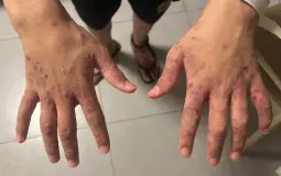 الجرب يجتاح زنازينهن