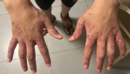الجرب يجتاح زنازينهن