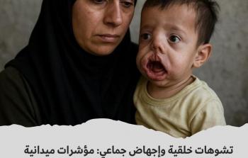تشوهات خلقية