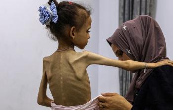 طفلة في غزة تعاني من سوء التغذية. يواجه قطاع غزة خطرا شديدا لحدوث المجاعة، فيما تزداد التقارير عن وفاة أشخاص بسبب الجوع وسوء التغذية