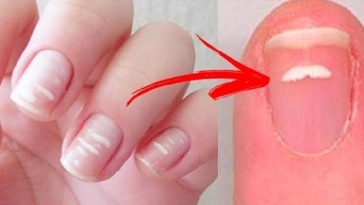 العلامات البيضاء على الاظافر