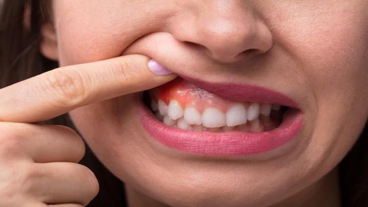 5وصفات منزلية سهلة لعلاج التهاب اللثة