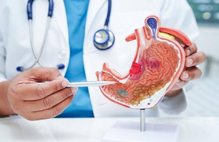 قرحة المعدة