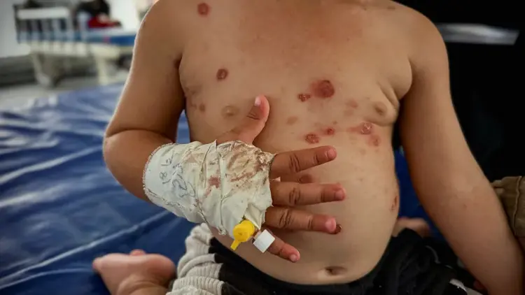 تفاقم انتشار مرض جدري الماء في قطاع غزة