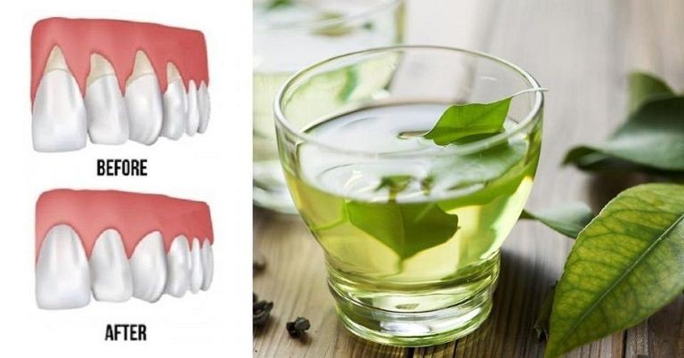 47-102619-treatment-of-gingivitis-at-home-8.jpeg